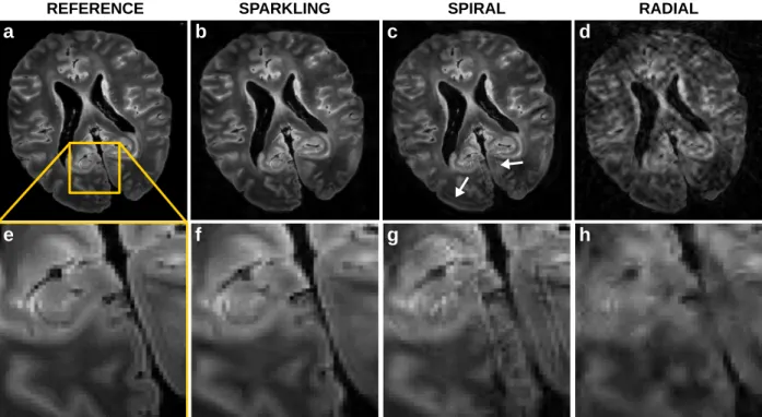 Figure 4: Comparison of SPARKLING sampling with variable-density spiral and radial tra- tra-jectories