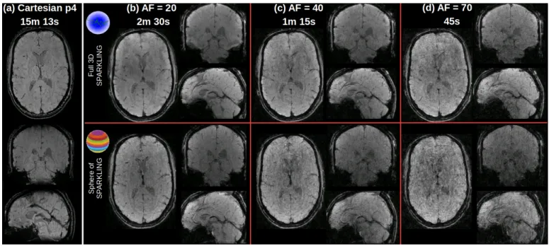 Fig. 8: Comparison of prospective results for globally optimized 3D SPARKLING (top row) and SpSOS (bottom row) for varying acceleration factors (from left to right, AF=20 (b), 40 (c) and 70 (d)) on in vivo human brain scans.
