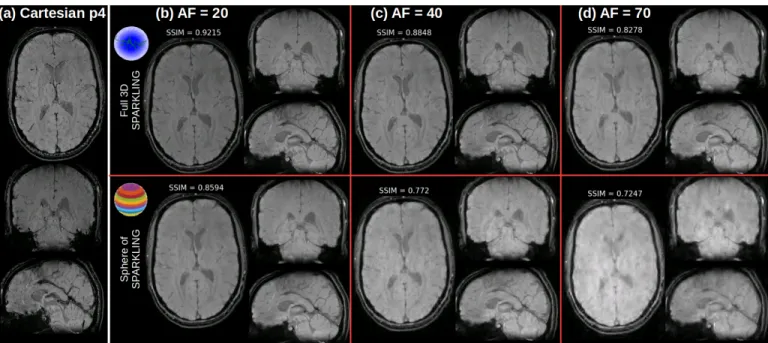 Fig. 7: Comparison of retrospective results for globally optimized 3D SPARKLING (top row) and SpSOS (bottom row) for varying acceleration factors (from left to right, AF=20 (b), 40 (c) and 70 (d)) on in vivo human brain scans.