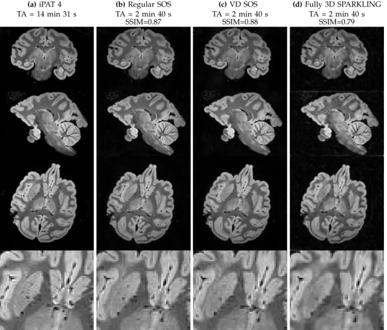 Fig. 5. 600 µm isotropic ex vivo results comparing different SPARKLING strategies. Column (a): iPAT 4 (GRAPPA) acquisition lasting TA=14min31s