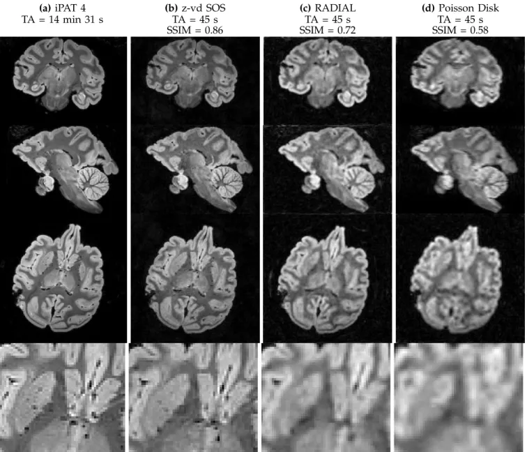 Fig. 6. 0.6 mm isotropic ex vivo results comparing z-variable stack-of-sparkling (SOS), 3D radial and 3D Poisson disk lines (PD-lines) sampling for a total number of shots of 1140, i.e., an acquisition time of 45 s