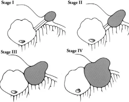 Figure  7 :  illustration  schématique  des  4  stades  de  neurinome  de  l’acoustique  selon  la  classification  de  Koos