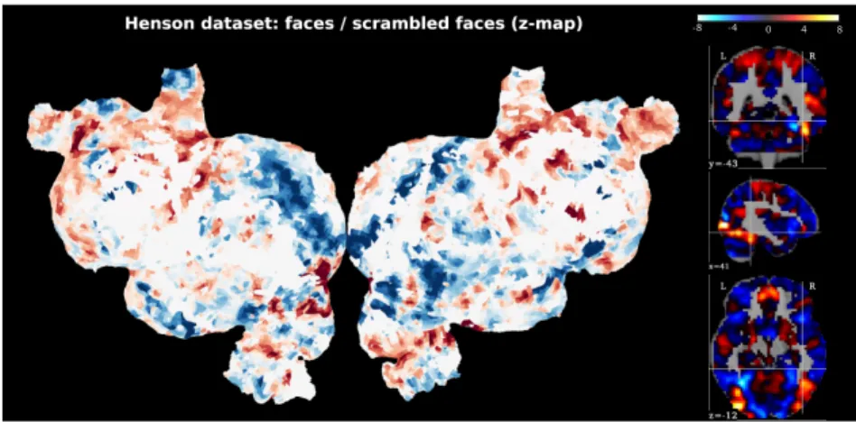 Figure 1.6: Example of brain activation maps: Beta maps for a visual stimulus. The thresholding of the left hand side image is arbitrary and for visualization purpose only.