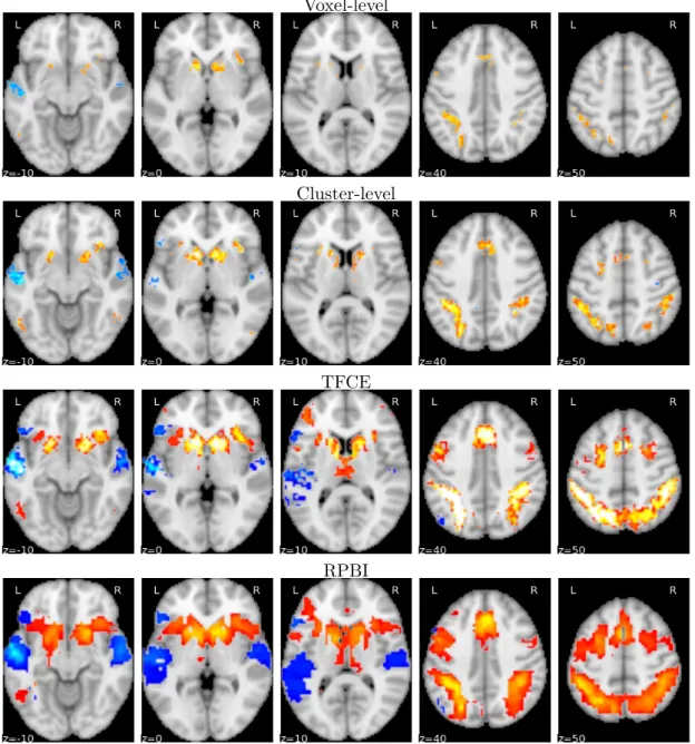 Figure 6: Impact of including the spatial context into neuroimaging statistical inference pro- pro-cedure: the four maps above represent the activation related to the one-sample test presented in Fig