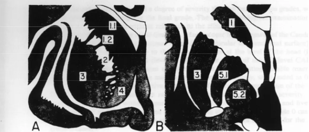 Figure 15 : Niveaux de coupe coronale étudiés dans la classification neuropathologique de la maladie par  Vonsattel 