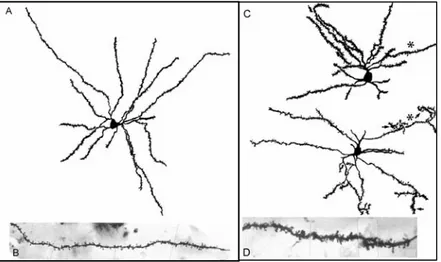 Figure 19 : Morphologie des neurones épineux au stade II de la maladie  