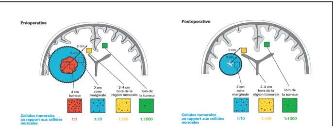 Figure 27 : Représentation des propriétés infiltrantes des cellules de glioblastome en pré- et post-opératoire