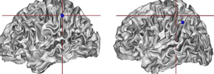 Fig. 1. Definition of the top of the posterior Sylvian Fissure sulcus in two brains in a normalized space (MNI space, affine coregistration)