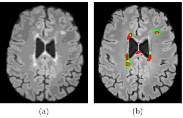 Fig. 2. Visual results. (a) Pre-processed FLAIR image requantized to 20 grey levels.