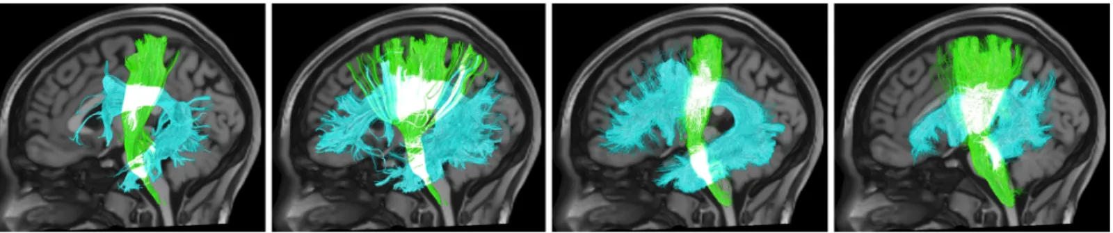 Figure 1. Variation in white matter bundle segmentation. Four example segmentations of the corticospinal tract (green) and arcuate fasciculus  (cyan) show variability in the size, shape, densities, and connections of these reconstructed white matter pathwa