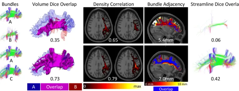 Figure  4.  Similarity  and  dissimilarity  metrics  to  assess  reproducibility.  Example  SLF  datasets  are  used  to  illustrate  a  range  of  similarity  values  between bundles A and B (top) and between bundles A and C (bottom)