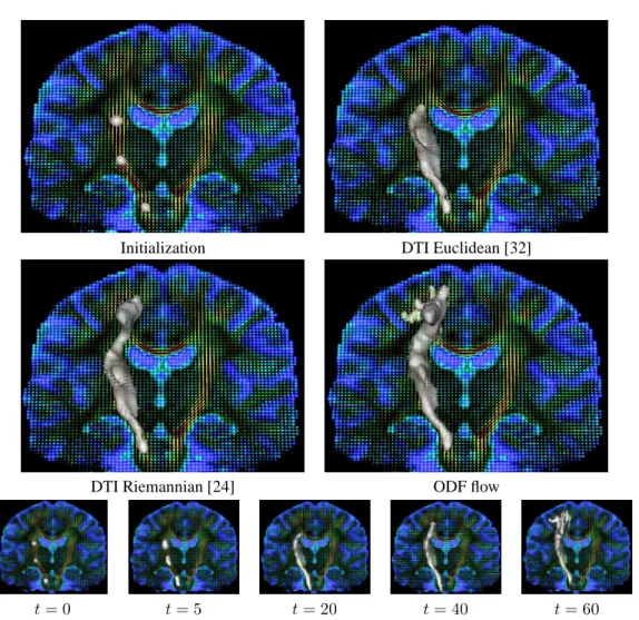 Figure 10: ODF flow can propagate through crossing regions and get a more accurate segmentation of the cortico-spinal tract (CST)