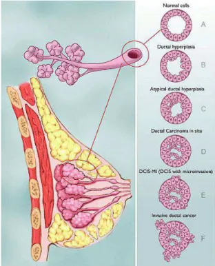 Figure 1: Simplified anatomy of the breast and different stages of the evolution of a duct carcinoma.