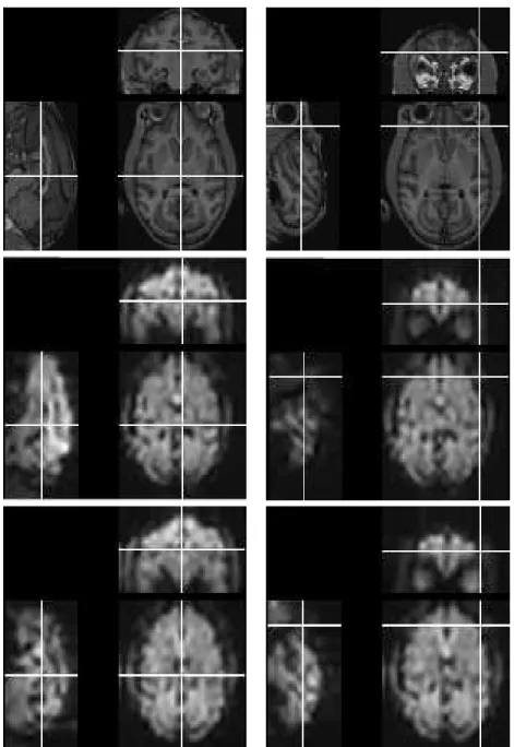 Figure 3: Global algorithm with fMRI data. Top row: reference anatomical MRI. Middle row: initial fMRI volume