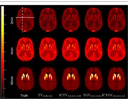 Fig. 4 Dynamic PET simulations with PE2i radiotracer: reconstruction methods with spa- spa-tiotemporal regularization.