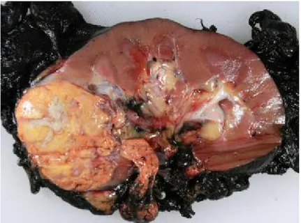 Figure 4: Picture of a Clear cell renal cell carcinoma 