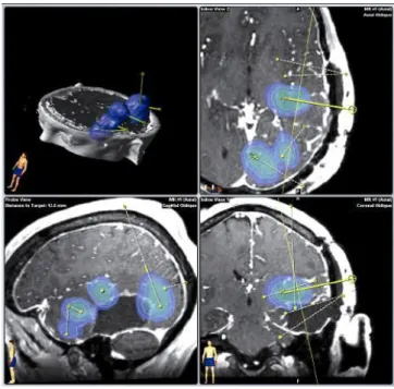 Figure 14 : exemple de simulation de délivrance avec  le logiciel de simulation de la Duke University  (Sampson 2007) 