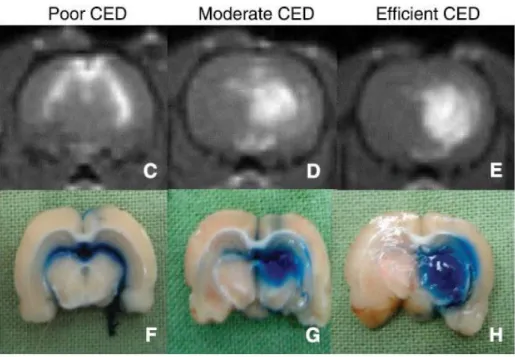 Figure  16 :  exemple  de  comparaison  entr e  l tude  de  la  dist i utio   e   I‘M  et  su   des  oupes  histologiques montrant une fuite majeure dans les ventricules (C, F), un recouvrement partiel de la  cible du fait de fuites (D,G) et une infusion o