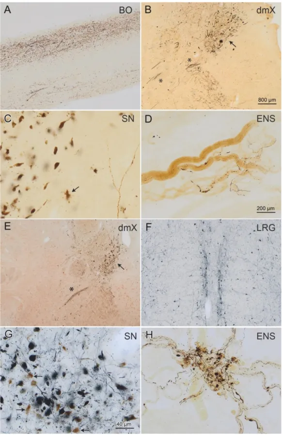 Figure 1. α-Synuclein-immunopositive Lewy neurites/bodies in n = 3 cases staged for LBD and  tested for amplification