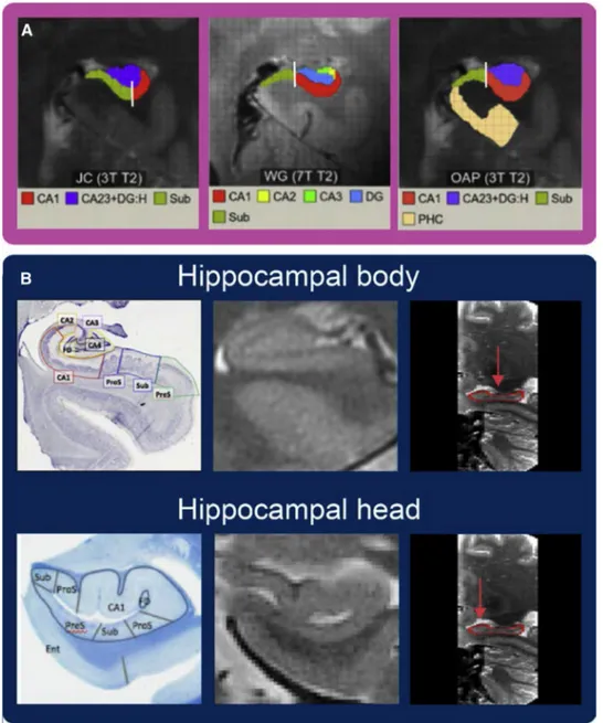 Fig. 2. (A) Examples of the variability in the position of the CA1, subiculum/prosubiculum boundary (white line) across three different segmentation protocols overlaid on the same brain (adapted from Yushkevich et al., 2015, Fig