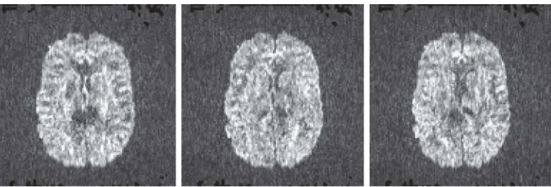 Figure 3.23: Diﬀusion weighted images (b=1500 s.mm 2 ) for three diﬀerent orienta- orienta-tions