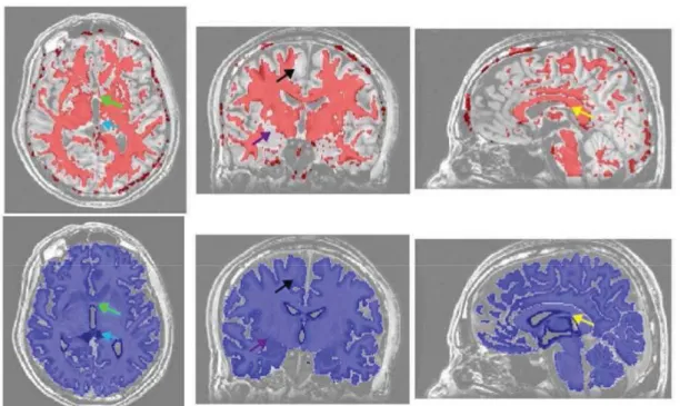 Figure 4.2: Robust Tractography mask (ﬁgure from [Guevara et al., 2011a]).First line: mask with a simple FA threshold, second line: T 1 -based mask