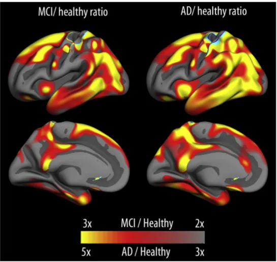 Figure 1: Différences dans les vitesses d’atrophie corticale entre des sujets sains, des sujets  MCI  (Mild  Cognitive  Impairment)  et  des  sujets  atteint  d’Alzheimer