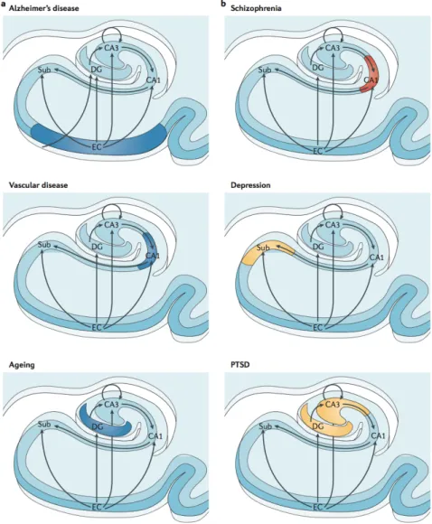 Figure  2:  Vulnérabilité  régionale  et  état  métabolique  de  la  formation  hippocampique  différenciant  les  pathologies