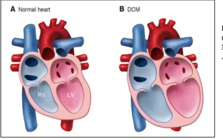 Figure  8:  Morphological  changes  of  the  heart  in  cardiomyopathy.  (A)  Normal  heart