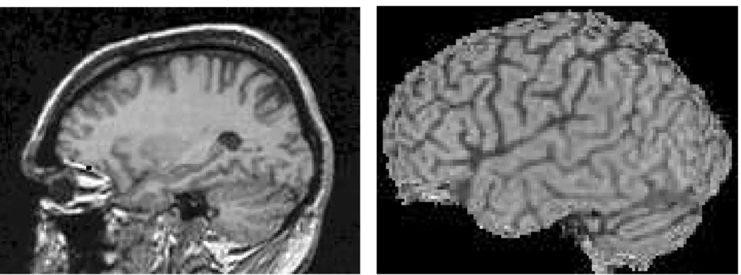FIG. 1. MR images (sagittal projections): top of a head and isolated brain The brain contained in the pre-processed image is composed of three constituents: