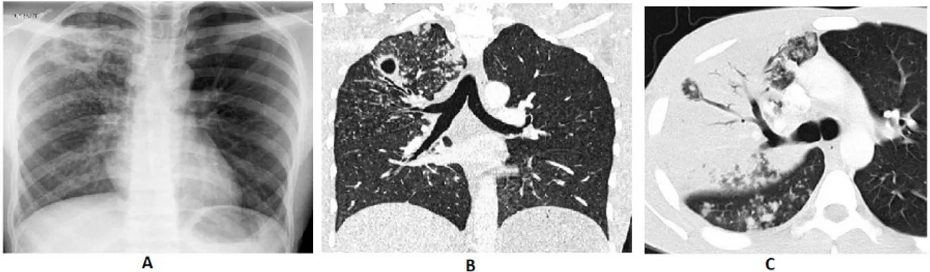 Figure  6  :  Image  radiographique  du  thorax  d’un  tuberculeux  (A),  image  cavitaire  apicale  droite et des micronodules en coupe tomodensitométrie (TDM) (B ), scanner de la bronche de  drainage (C) (Carette 2002)
