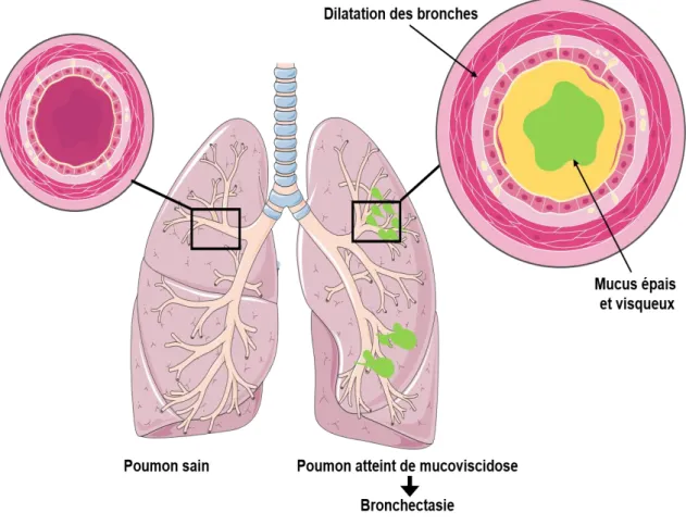 Figure  8 :  Comparaison  entre  une  bronche  saine  et  une  bronche  atteinte  de  bronchectasie
