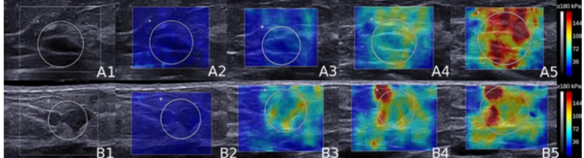 Figure 2: Supersonic Shear Wave Elastography (SSWE) color maps of a benign (A) and a malignant (B)  mass on B-mode (1), and for the different compression levels, respectively none (2), mild (3), moderate (4) 
