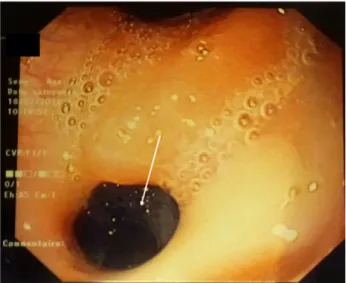 Figure 2: Control X-ray after the double pigtailed drain has been put up.