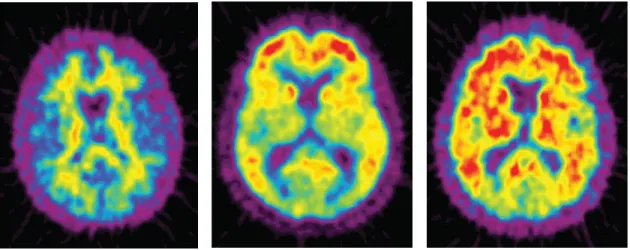 Figure 4 : Visualisation in vivo du dépôt de plaques amyloïdes  