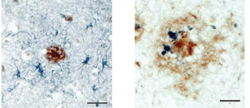 Figure 9 : Illustration de la gliose péri-plaques 