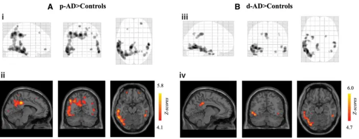 Figure 10 : Visualisation in vivo de l’activation de la microglie dans le cerveau de patients avec  MA 