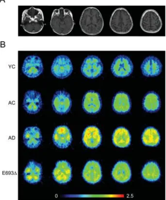Figure 17 : Visualisation in vivo de la charge amyloïde dans le cerveau de patients porteurs de  la mutation E693Δ  