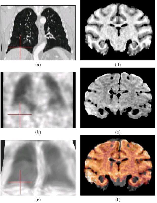 Fig. 1.12 – Comparaison de la d´eformation du thorax due `a la respiration (CT respiration maximale (a), TEP transmission respiration normale (b) et TEP transform´ee par FFD dans la g´eom´etrie du CT (c) ) et de la d´eformation du cerveau due `a la perte d