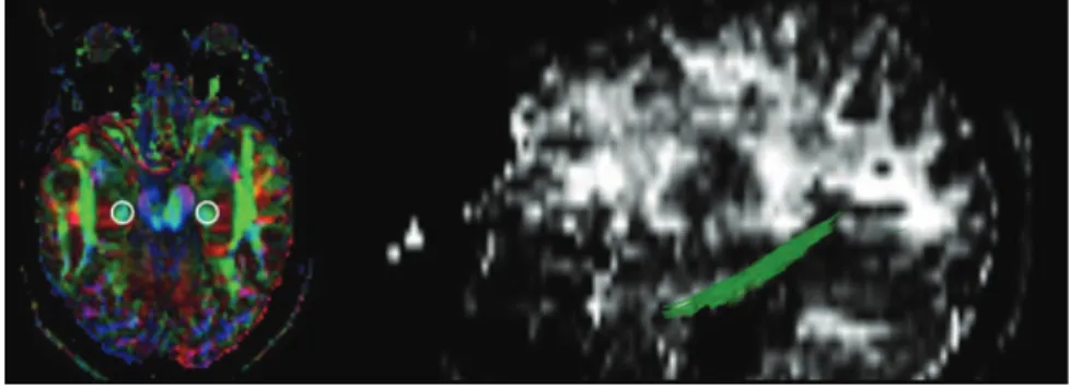 Figure 2. ROI placement for inferior cingulum tract selection. Color-coded maps were used to represent tract  in-formation