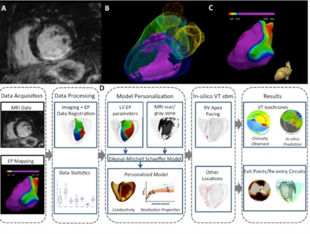 Figure  1  (A)  high-resolution  contrast-enhanced  CMR  scar  images;  (B)  whole  heart  model  segmented from 3D steady-state free precession (SSFP) CMR with scar (core and gray zone)  in  violet;  (C)  low  voltage  areas  from  electroanatomical  mapp