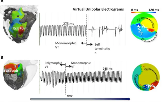 Figure 4. Isochrones map during re-entrant VT. 