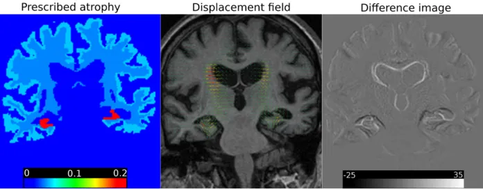 Figure 2: Atrophy in cortex, white matter and Hippocampus. No atrophy is prescribed in brain stem and other sub-cortical structures such as Thalami, Putamen etc