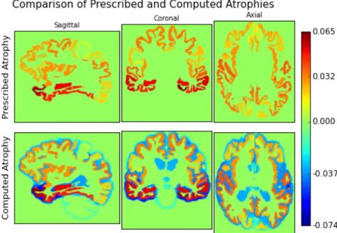 Figure 3: Prescribing uniform atrophy in 34 different cortical regions and in hippocampi