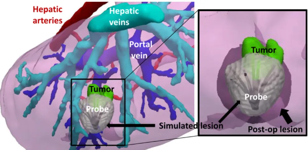 Fig. 4: Comparison between the simulated and the post-operative necrotic areas on tu- tu-mor 2-1