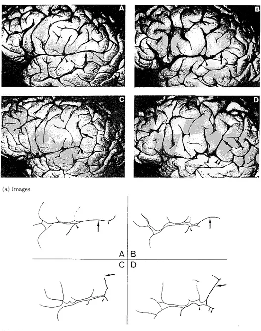 Figure 11 . — Variabilité de configurations du sillon latéral (figure issue de [21] )