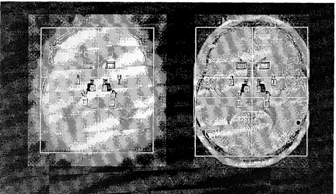 Figure 10. — Exemple de superposition d'images TEP et IRM et de l'atlas de Talairach digitalis é