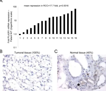 Figure 1: PLA2R1 expression decreases in clear cell renal cell carcinoma.  (A) RNAs were extracted from both normal and  cancer tissues from the same patients (n=16) and PLA2R1 transcript levels were assayed by qRT-PCR and normalized against PPIA
