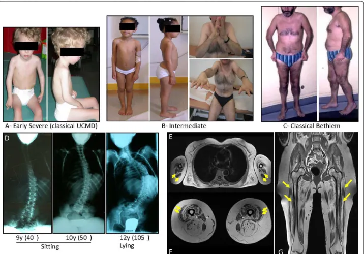Figure 2 Clinical spectrum, associated spine deformation and muscle MRI in collagen type VI (ColVI) myopathies