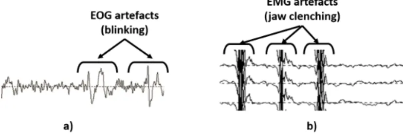 Figure 5: Examples of artefacts polluting EEG signals. a) Electrooculographics (EOG) artefacts due to blinking, b) Electromyographic (EMG) artefacts due to jaw clenching.